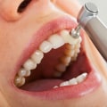 The Importance of Regular Dental Cleanings for Optimal Oral and Overall Health