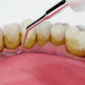 The Importance of Regular Teeth Cleaning and Scaling