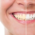 The Importance of Regular Dental Cleanings and How to Make Them More Affordable