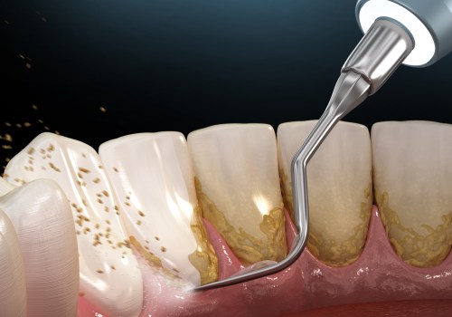 The Truth About Dental Scaling: Is it Really Painful?