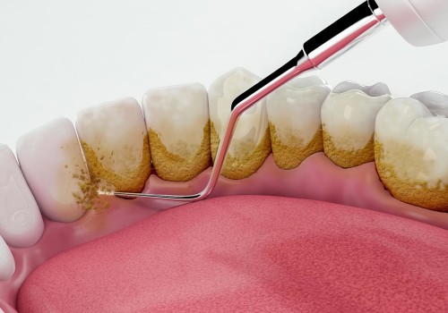 The Importance of Regular Teeth Cleaning and Scaling