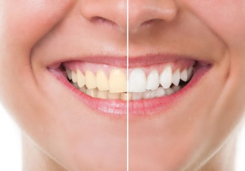 The Importance of Regular Dental Cleanings and How to Make Them More Affordable