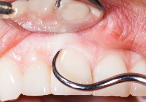 The Importance of Deep Dental Cleaning